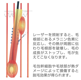 脱毛のメカニズム