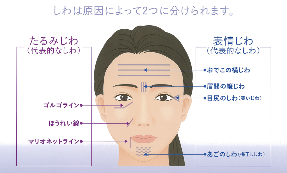 しわにも種類がある
