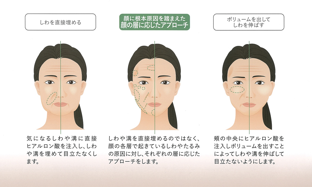 ヒアルロン酸の注入方法
