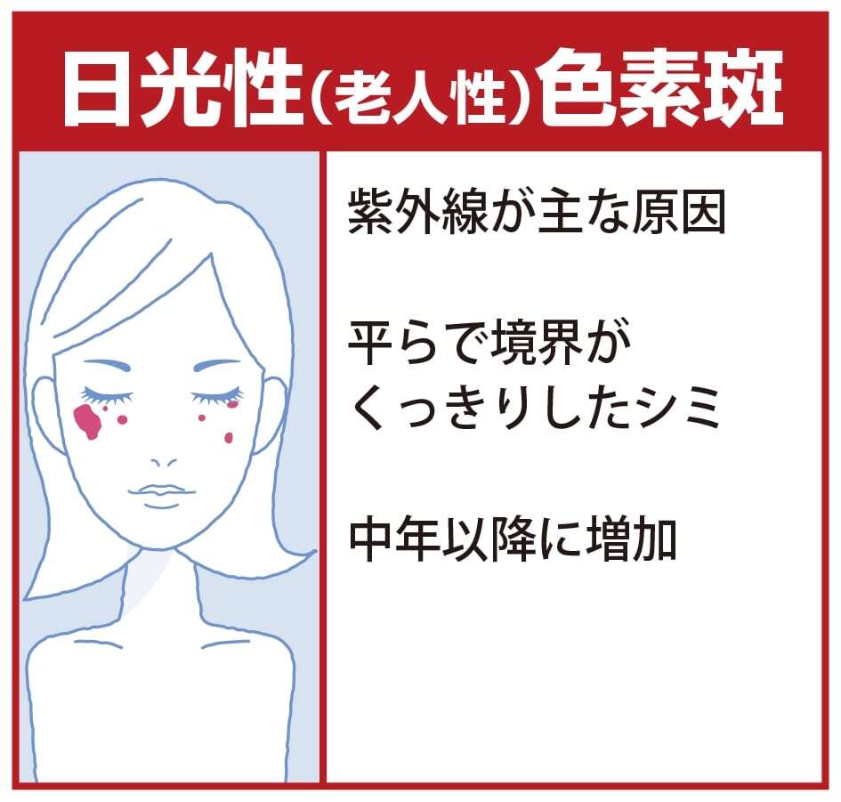 日光性（老人性）色素斑