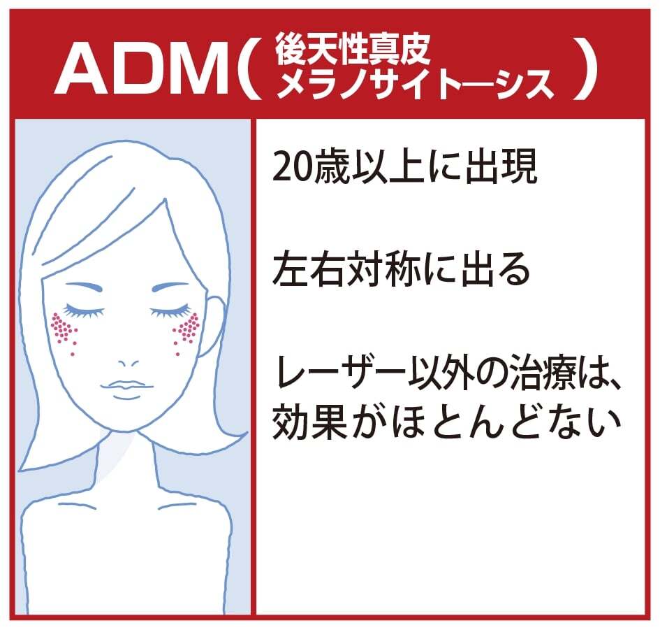 ADM（後天性真皮メラノサイト－シス）