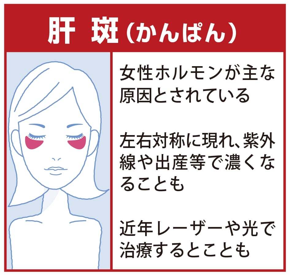 肝斑（かんぱん）
