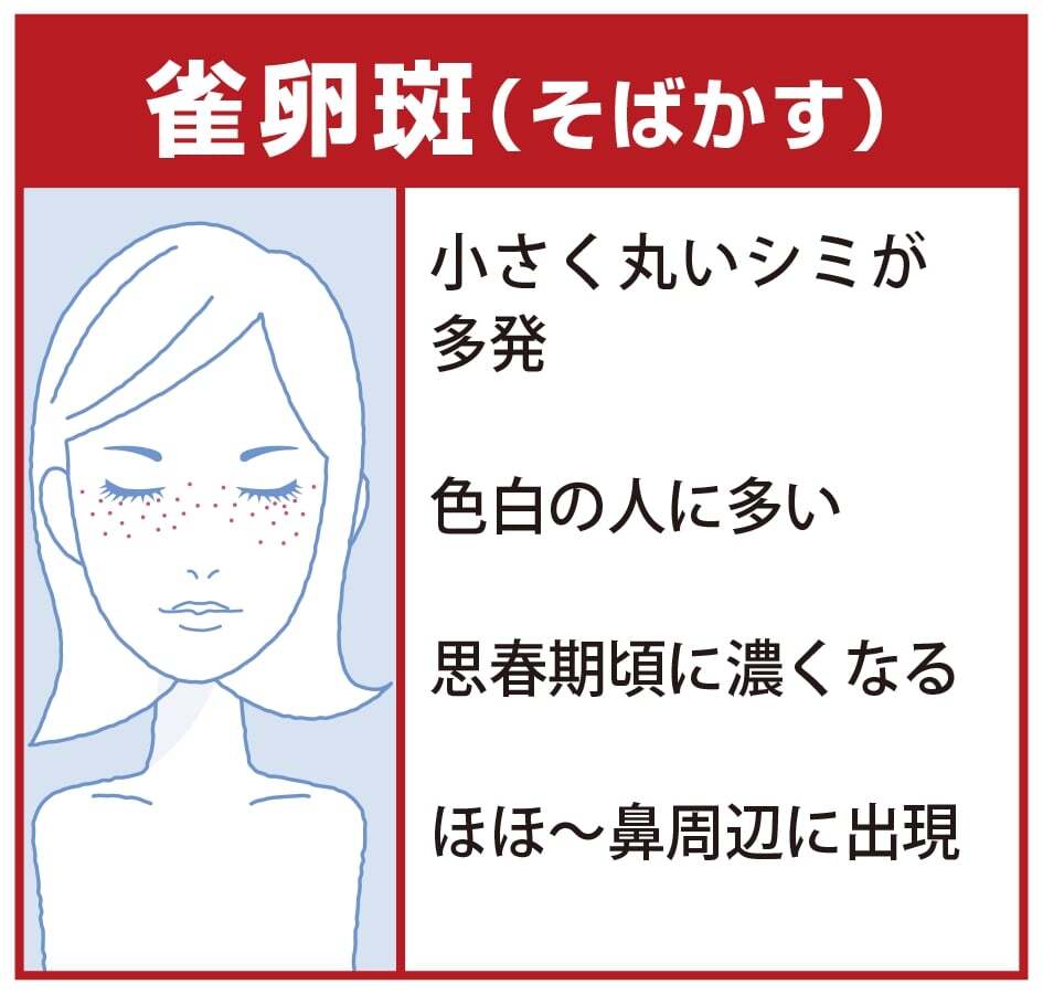 雀卵斑（そばかす）