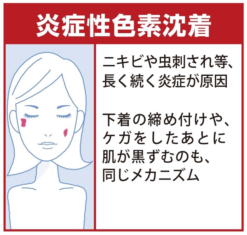 炎症性色素沈着