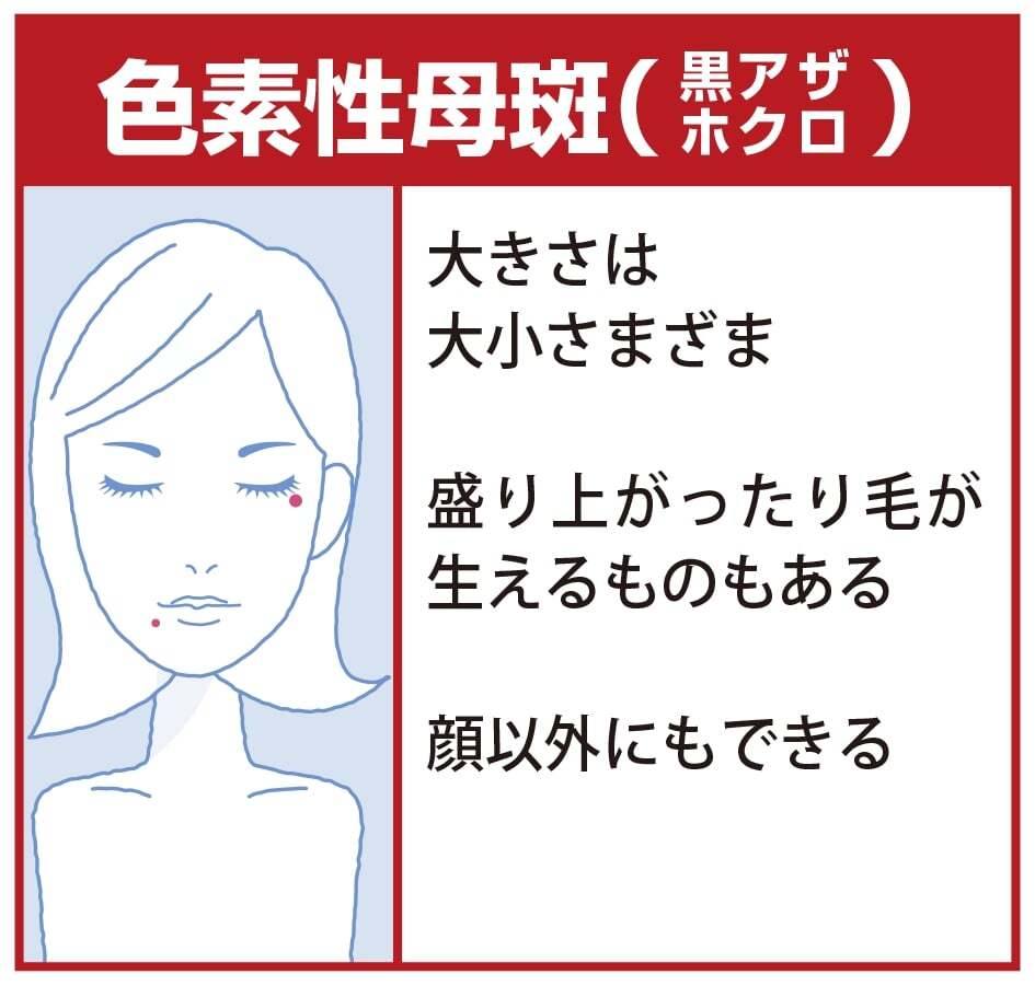 色素性母斑（黒あざ　ホクロ）