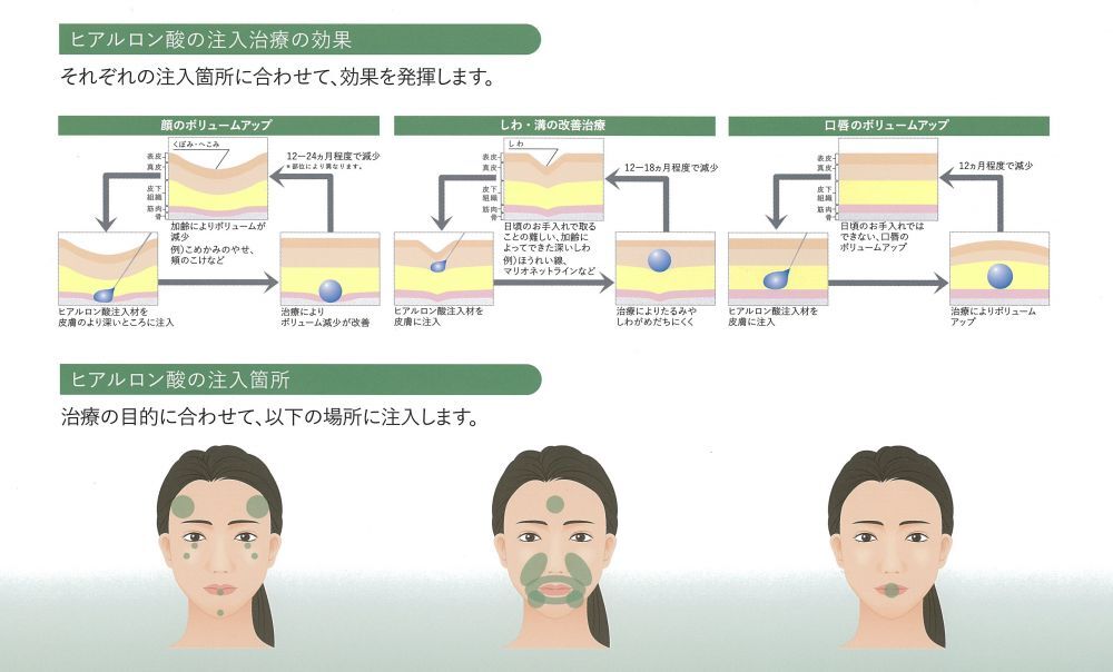 ヒアルロン酸の注入方法