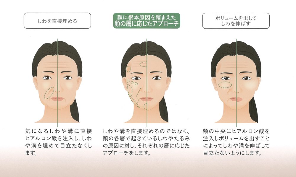 ヒアルロン酸の注入方法