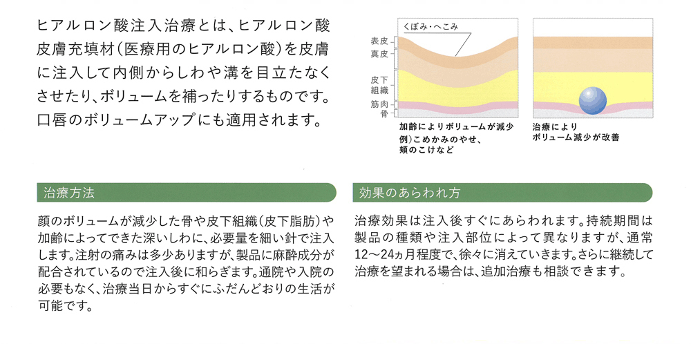 ヒアルロン酸注入治療について